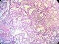 经典病例学习-乳腺浸润性筛状癌图14