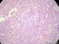 经典病例学习-乳腺浸润性筛状癌图12