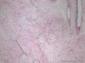 外阴血管肌纤维母细胞瘤图7