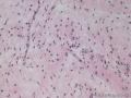 外阴血管肌纤维母细胞瘤图5