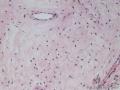 外阴血管肌纤维母细胞瘤图6