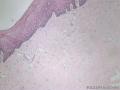 外阴血管肌纤维母细胞瘤图9