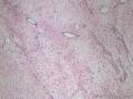 外阴血管肌纤维母细胞瘤图8