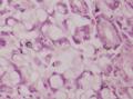 胃角粘膜 印戒细胞癌图7