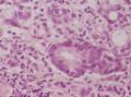 胃角粘膜 印戒细胞癌图14