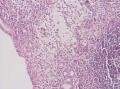 胃角粘膜 印戒细胞癌图4