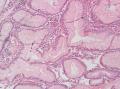 胃角粘膜 印戒细胞癌图30