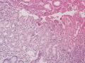 胃角粘膜 印戒细胞癌图16