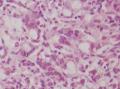 胃角粘膜 印戒细胞癌图11