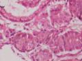 胃角粘膜 印戒细胞癌图26
