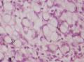 胃角粘膜 印戒细胞癌图5