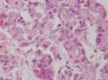 胃角粘膜 印戒细胞癌图23