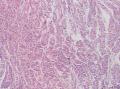胃角粘膜 印戒细胞癌图18