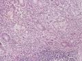 胃角粘膜 印戒细胞癌图2