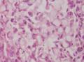 胃角粘膜 印戒细胞癌图9