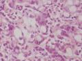 胃角粘膜 印戒细胞癌图6