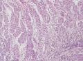 胃角粘膜 印戒细胞癌图19