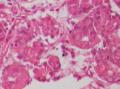 胃角粘膜 印戒细胞癌图24