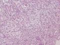 胃角粘膜 印戒细胞癌图1