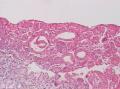 胃角粘膜 印戒细胞癌图17
