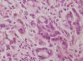 胃角粘膜 印戒细胞癌图12