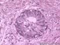乳腺纤维腺病图2