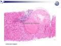 肝脏病理学讲座稿件图39
