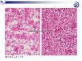 肝脏病理学讲座稿件图29