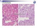 肝脏病理学讲座稿件图36
