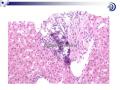 肝脏病理学讲座稿件图38