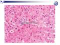 肝脏病理学讲座稿件图22