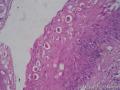 女，33岁，扁桃体新生物，请问表皮上的空泡状细胞是什么？图3