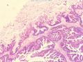 2013年第01期（总第53期)—右侧卵巢囊性肿瘤(已点评）图11