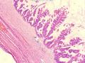 2013年第01期（总第53期)—右侧卵巢囊性肿瘤(已点评）图14