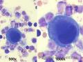 大家看看国外一病例？Pleural fluid cytology图3