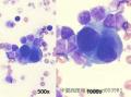 大家看看国外一病例？Pleural fluid cytology图4