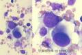 大家看看国外一病例？Pleural fluid cytology图2