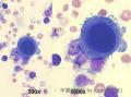 大家看看国外一病例？Pleural fluid cytology图1