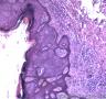 皮肤肿物，表皮内见部分细胞成团，大小较一致，可见核分裂像图5