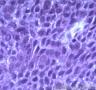 皮肤肿物，表皮内见部分细胞成团，大小较一致，可见核分裂像图13