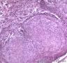 皮肤肿物，表皮内见部分细胞成团，大小较一致，可见核分裂像图9