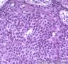皮肤肿物，表皮内见部分细胞成团，大小较一致，可见核分裂像图12