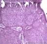 皮肤肿物，表皮内见部分细胞成团，大小较一致，可见核分裂像图8