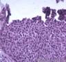 皮肤肿物，表皮内见部分细胞成团，大小较一致，可见核分裂像图11