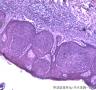 皮肤肿物，表皮内见部分细胞成团，大小较一致，可见核分裂像图4