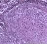 皮肤肿物，表皮内见部分细胞成团，大小较一致，可见核分裂像图10