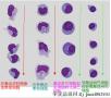 结核脑膜炎细胞学特点--今天发现的病例总结图21