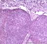 皮肤肿物，表皮内见部分细胞成团，大小较一致，可见核分裂像图2