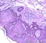 皮肤肿物，表皮内见部分细胞成团，大小较一致，可见核分裂像图3