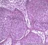 皮肤肿物，表皮内见部分细胞成团，大小较一致，可见核分裂像图7